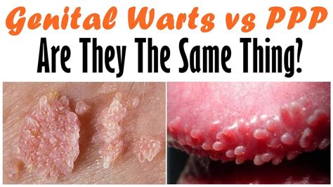 men's pp|penile papules vs warts.